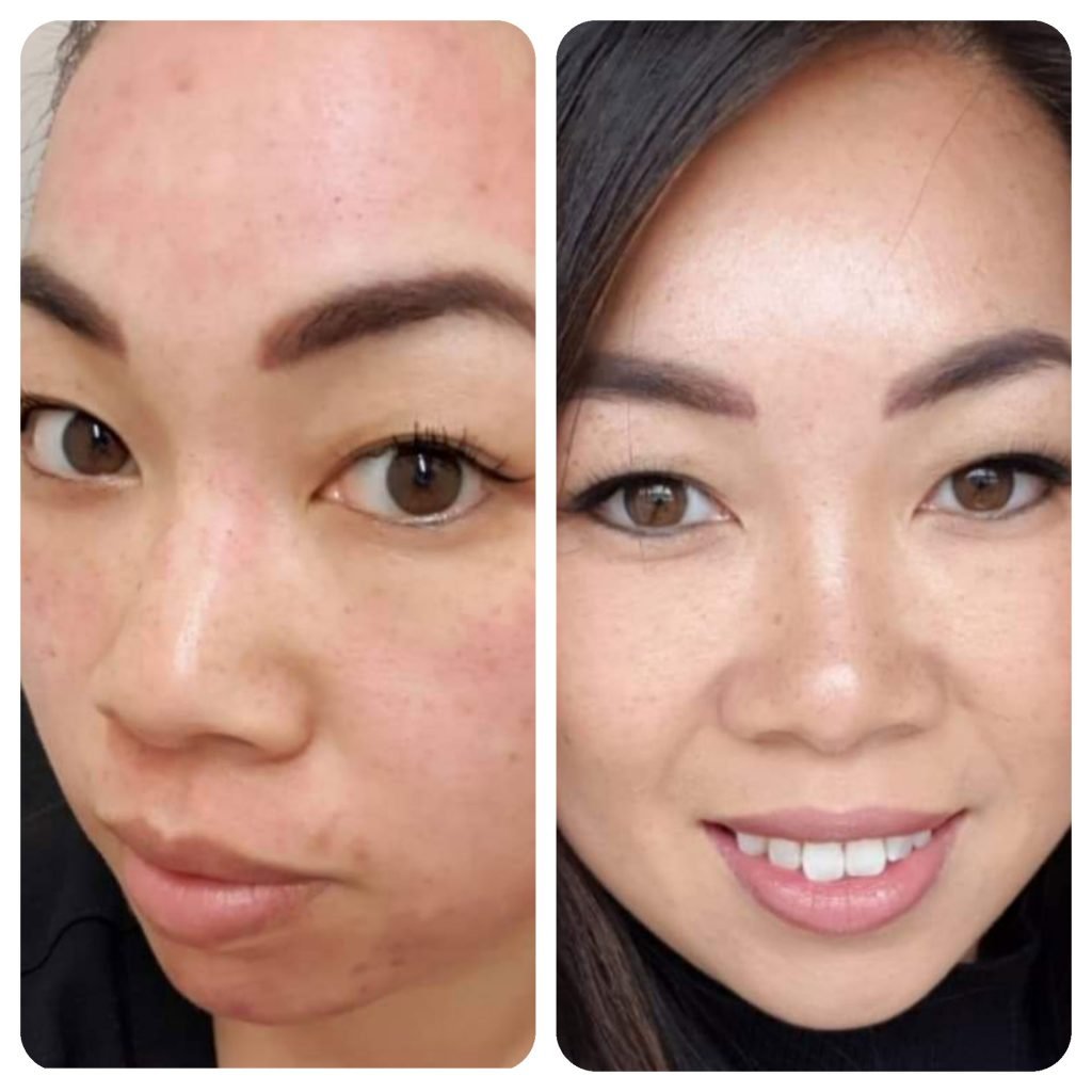 Image of customer before and after microneedling treatment.